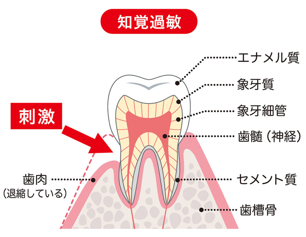 知覚過敏の図